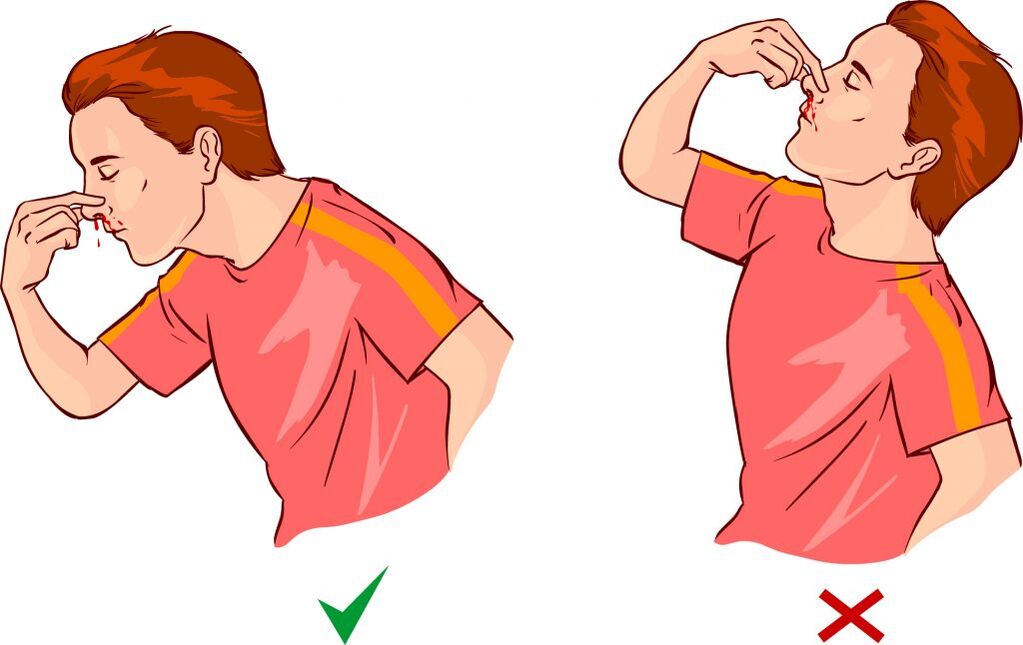Epistaxis hipertensijai